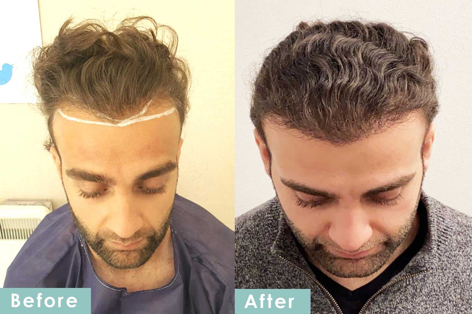 Natural Results with Westminster Medical Group® – Hair Transplant London