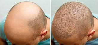 Hair Transplant Turkey: From Consultation to Recovery Explained