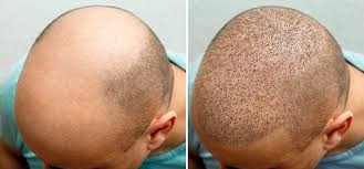 Hair Transplant Turkey: From Consultation to Recovery Explained