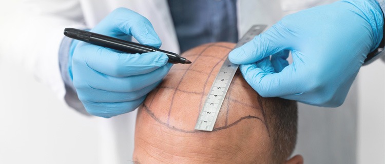 Hair Transplant Turkey – Trusted Experts in Hair Restoration