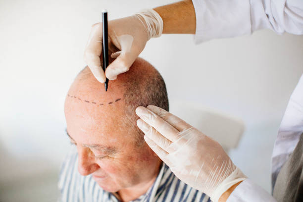 Hair Transplant Price in Istanbul: Affordable World-Class Treatment
